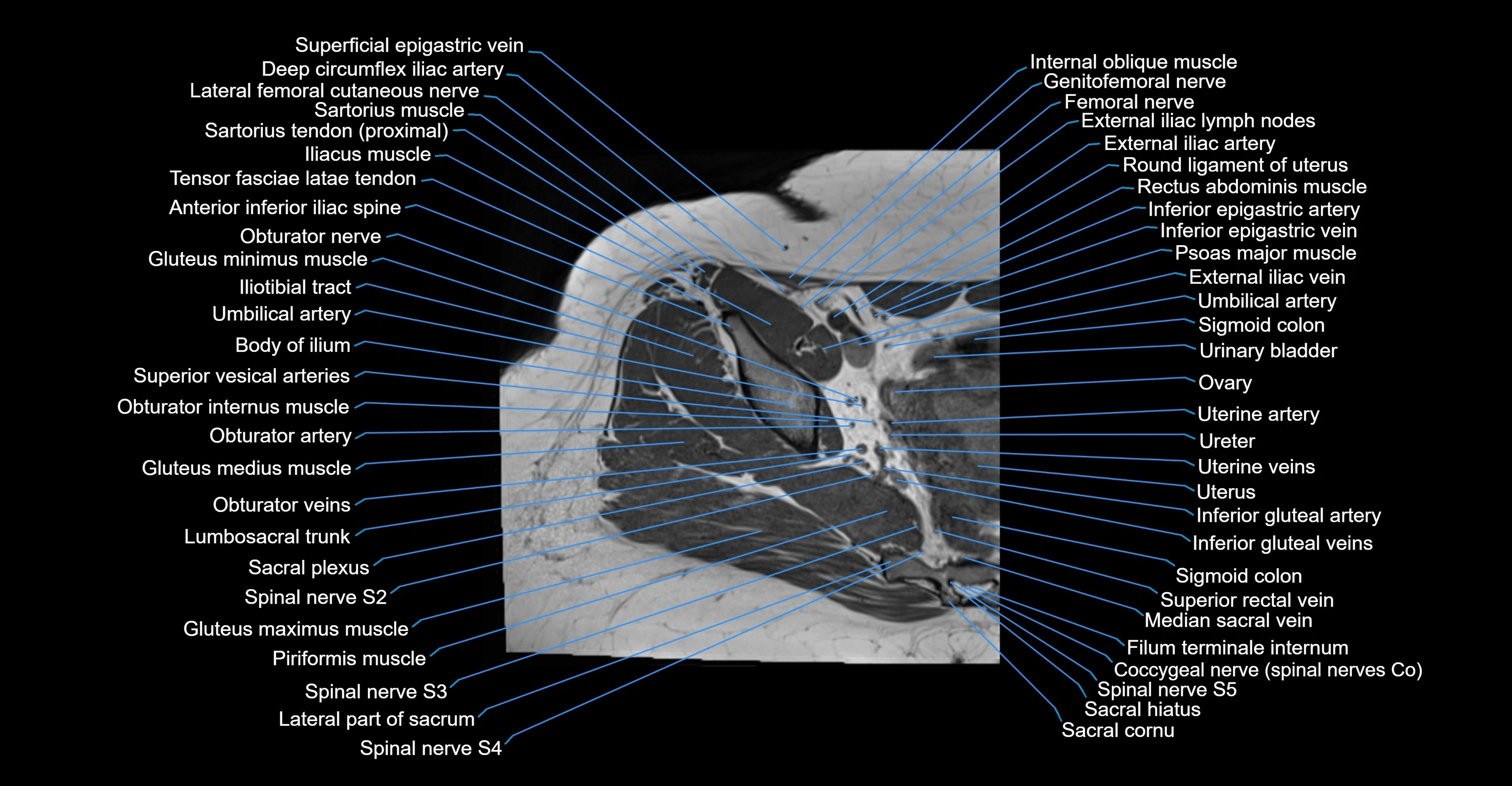 MRI hip axial cross sectional anatomy 3T 3D  radiology  anatomy image-img-00001-00017.webp
